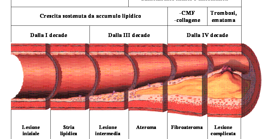 Inforcatura varicosity trattamento